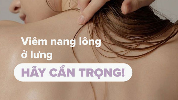 alt text: Hình ảnh viêm nang lông ở lưng, thể hiện các nốt sưng đỏ và viêm nhiễm