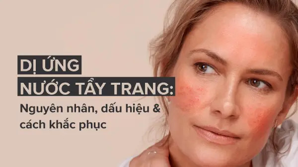 alt text: Nguyên nhân và cách khắc phục dị ứng nước tẩy trang. Hình ảnh chai nước tẩy trang và bông tẩy trang.