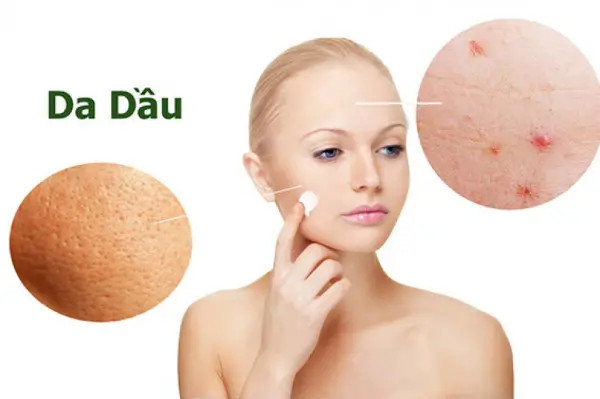 Da dầu rất dễ sinh mụn, tác hại của da dầu