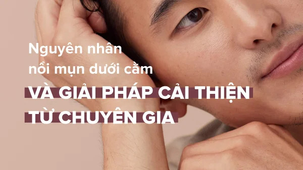 Nguyên nhân nổi mụn dưới cằm và giải pháp cải thiện từ chuyên gia