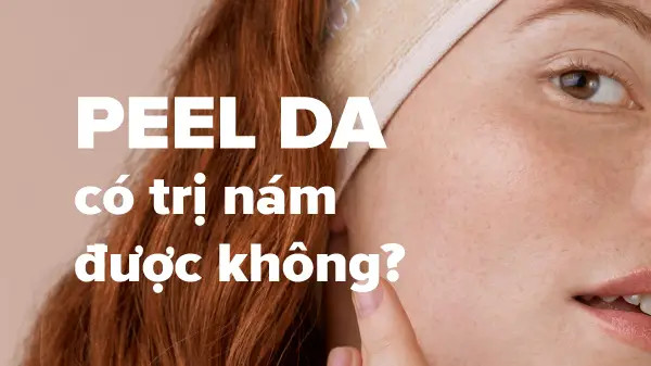 Peel da có trị nám được không?