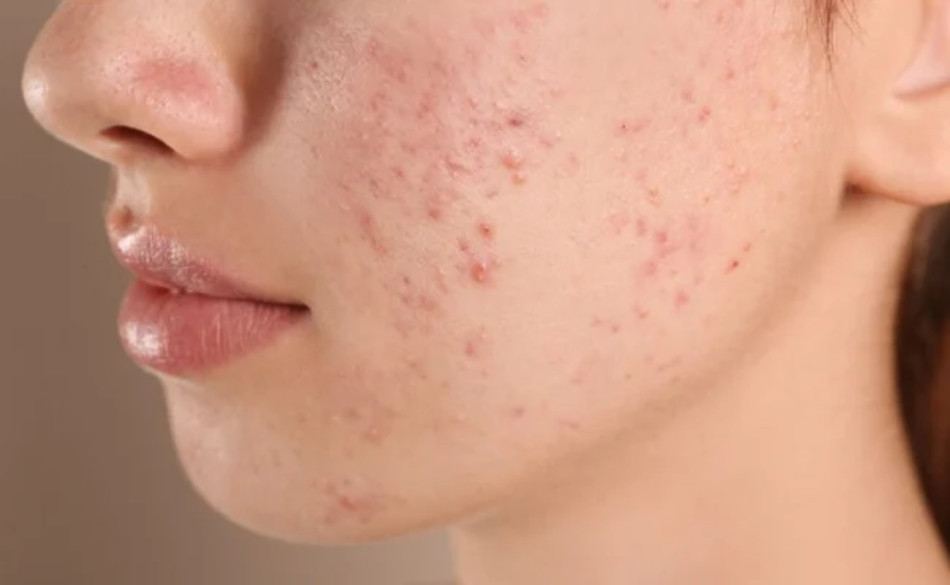 Các bước skincare trị mụn cho da dầu mụn ngày và đêm chi tiết