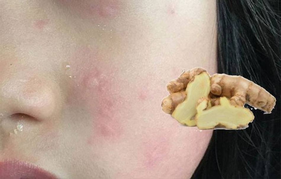 Nghệ trắng giúp điều trị nhiễm trùng và nấm da