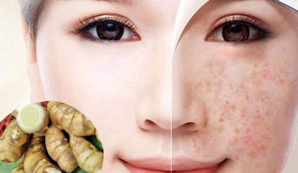 Nghệ trắng giúp làm mờ nám và tàn nhang