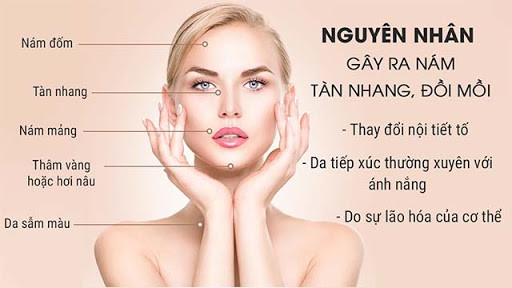 Những điều cần biết về nám, tàn nhang!