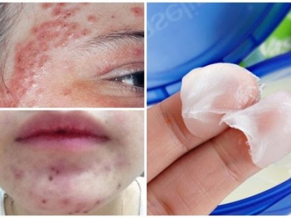 Những mối nguy khi sử dụng Vaseline trên da mặt