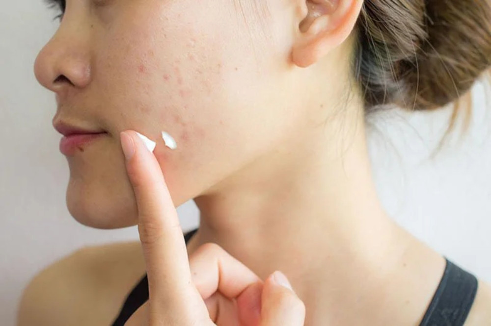 Sử dụng những loại kem bôi trị mụn ẩn