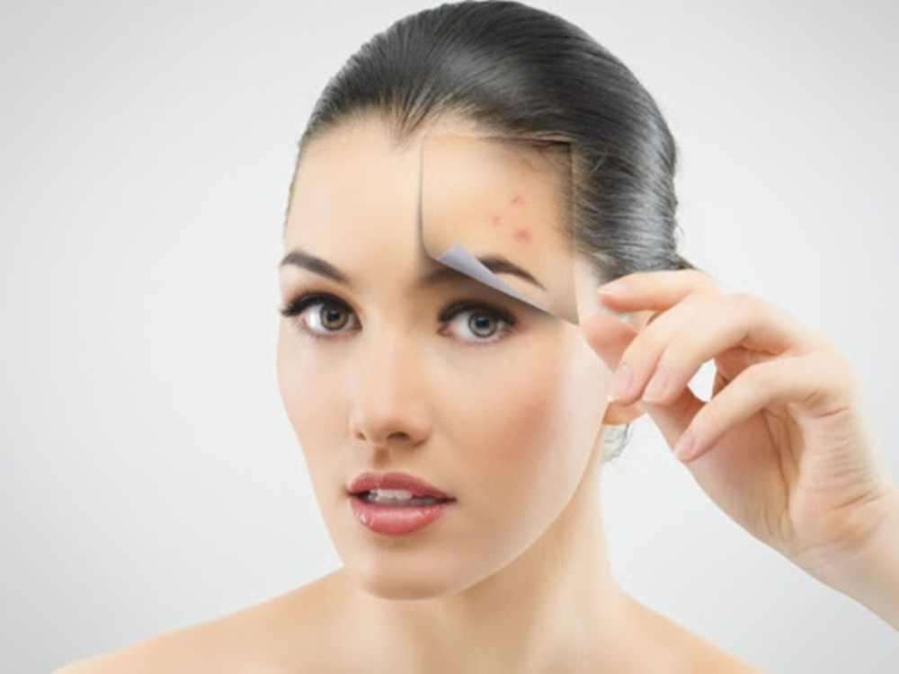 Xử lý mụn ở tuổi dậy thì đúng cách