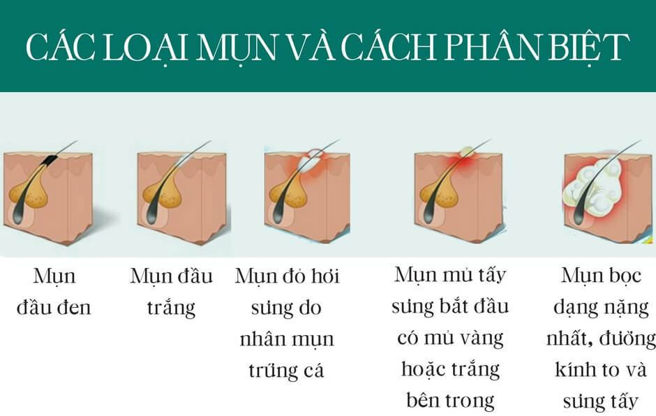 Tại Sao Trị Mụn Mãi Không Hết? Khám Phá Những Nguyên Nhân Và Giải Pháp