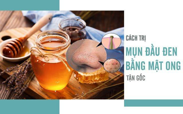 Cách trị mụn đầu đen bằng mật ong