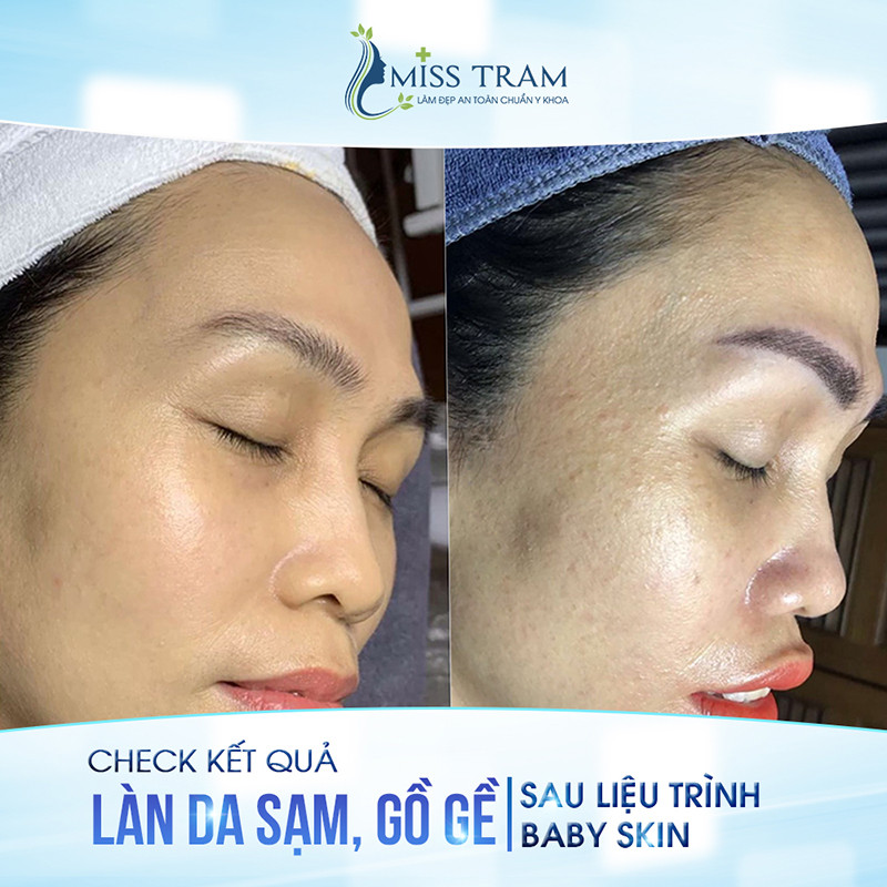 Cải Thiện Da Sạm, Gồ Ghề Bằng Liệu Trình Baby Skin