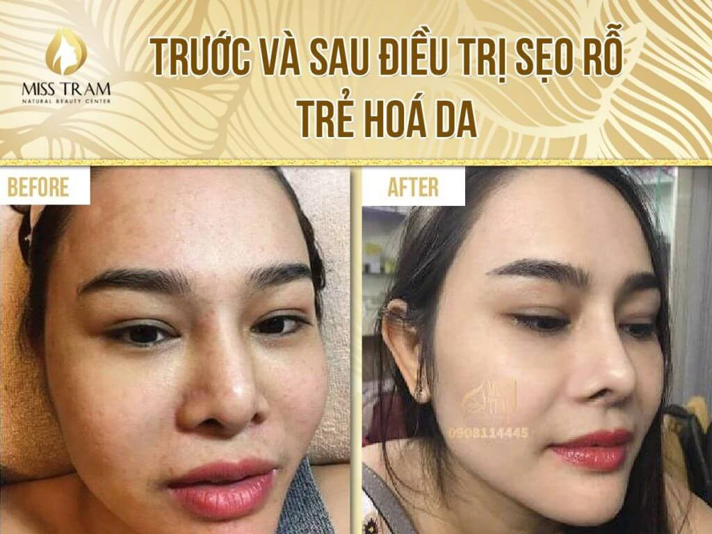 Cấy da siêu vi điểm với các tác dụng rõ rệt