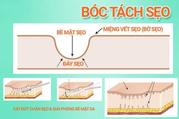 Hướng Dẫn Chăm Sóc Da Sau Khi Bóc Tách Sẹo: Đảm Bảo Làn Da Bạn Khỏe Mạnh