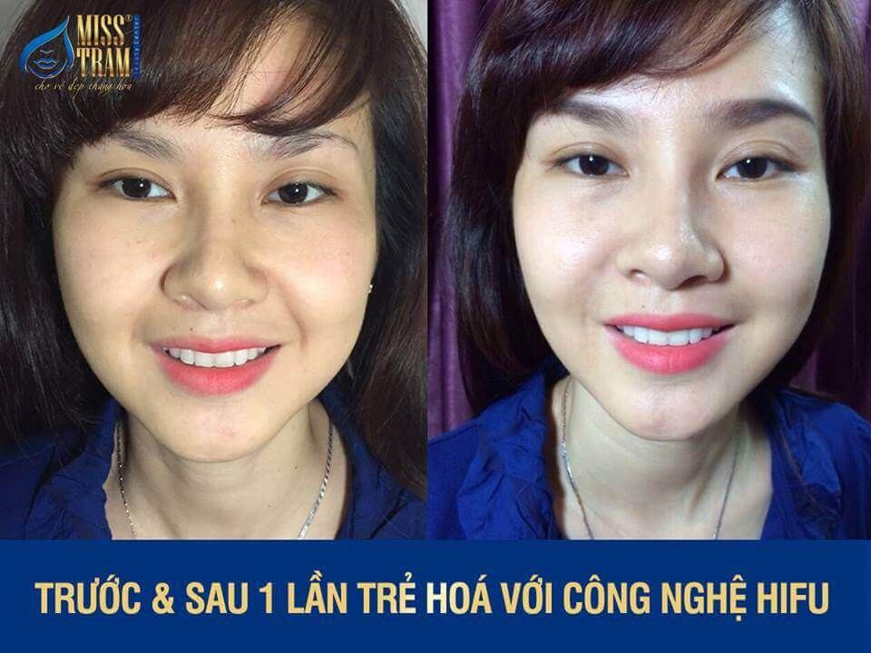 Công nghệ Hifu giúp trẻ hóa da