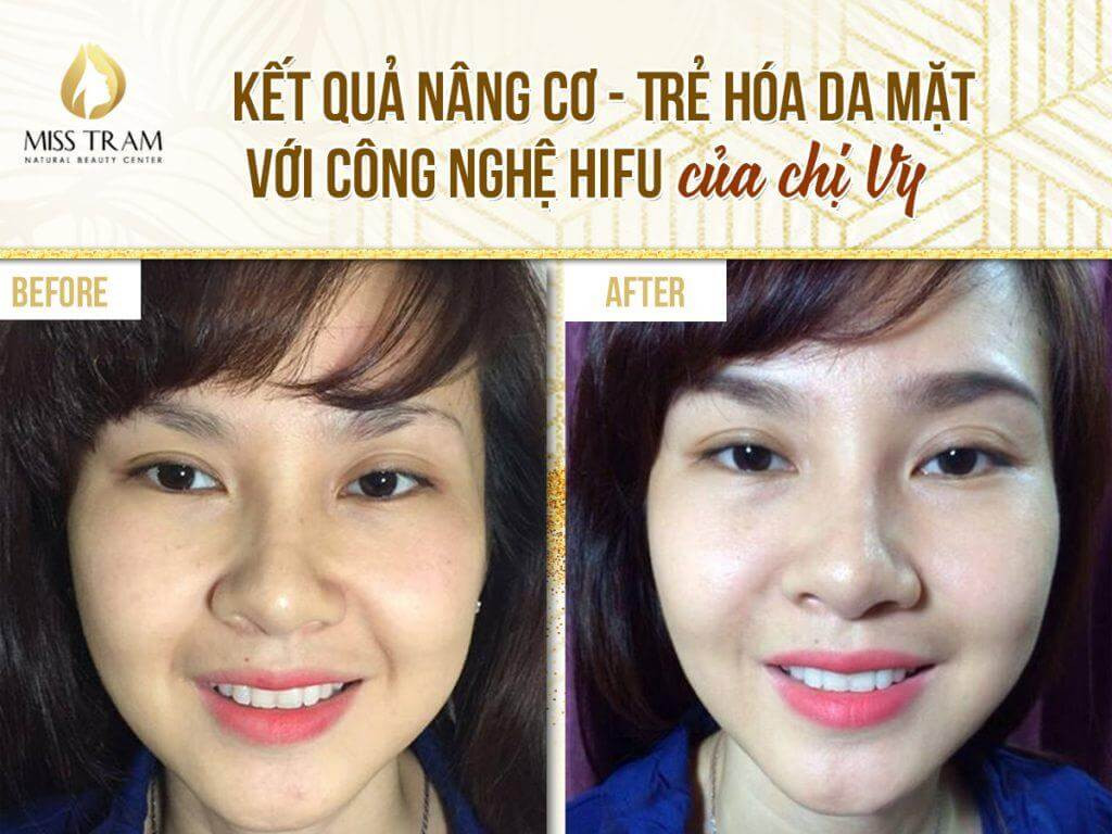 Công nghệ HIFU khắc phục da mặt bị cháy xệ uy tín