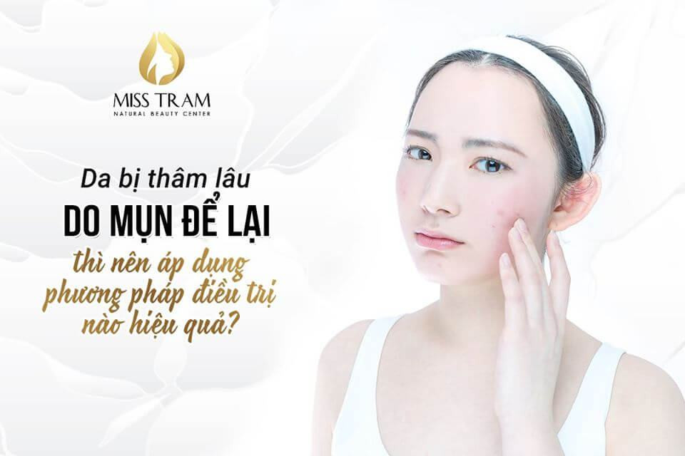 Giải Quyết Vấn Đề Da Bị Thâm Lâu Do Mụn: Áp Dụng Phương Pháp Điều Trị Nào Hiệu Quả?