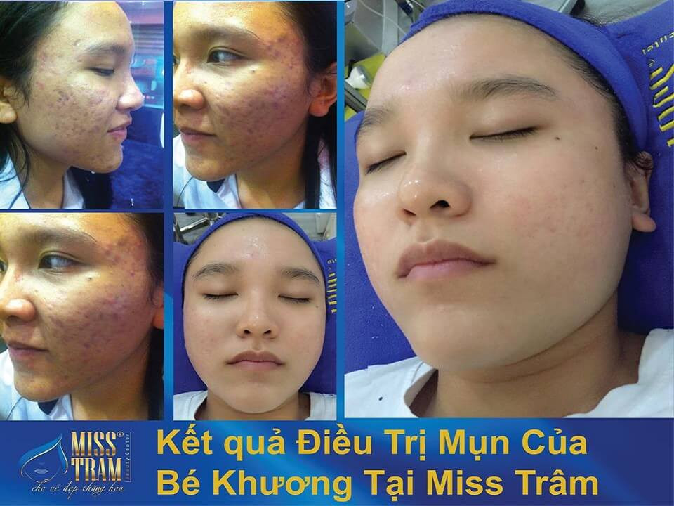 Kết quả điều trị mụn da liễu tại Miss Tram