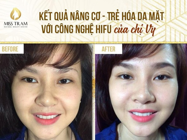 Kết quả nâng cơ trẻ hóa da mặt