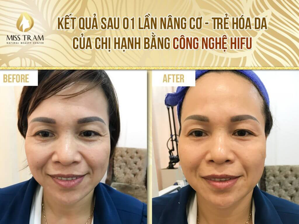 Kết quả trẻ hóa da bằng công nghệ HiFu