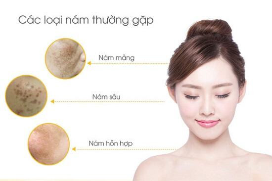 Hiểu Rõ Về Nám Da: Nguyên Nhân, Cách Chăm Sóc Hiệu Quả