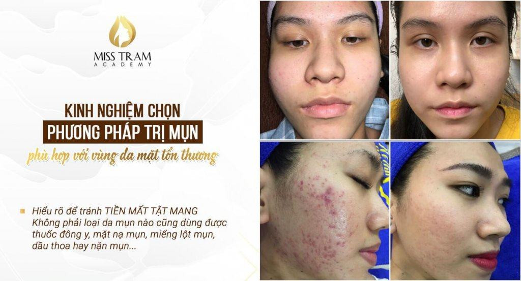 Lựa chọn phương pháp điều trị mụn phù hợp