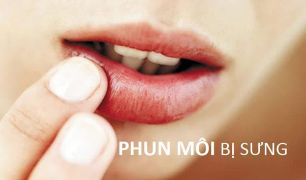 Môi sưng sau khi phun