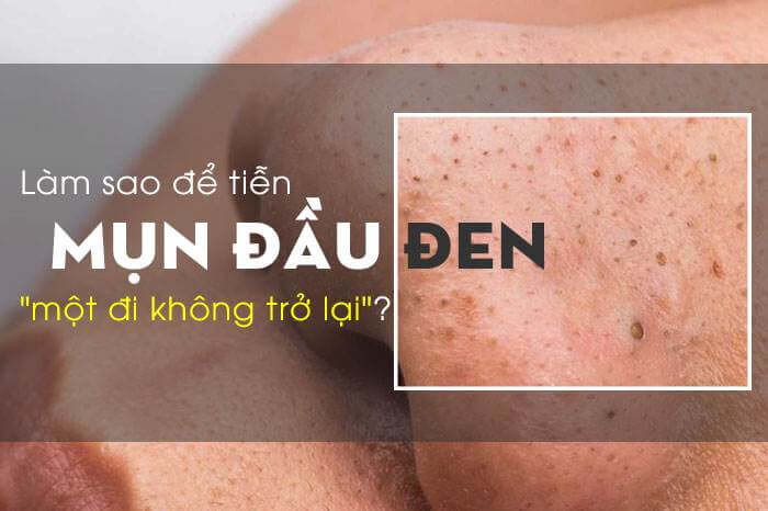 Mụn đầu đen không nên tự ý nặn