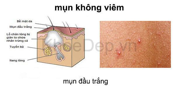 Cách Điều Trị Mụn Đầu Trắng Hiệu Quả Nhất Bạn Nên Biết