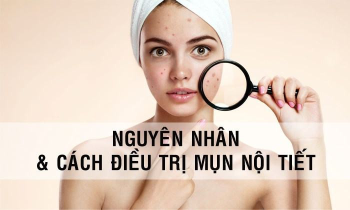 Cách Điều Trị Mụn Nội Tiết Hiệu Quả Dành Cho Nam và Nữ