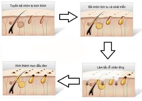 Mụn đầu đen: Nguyên nhân, cách trị và sản phẩm hiệu quả