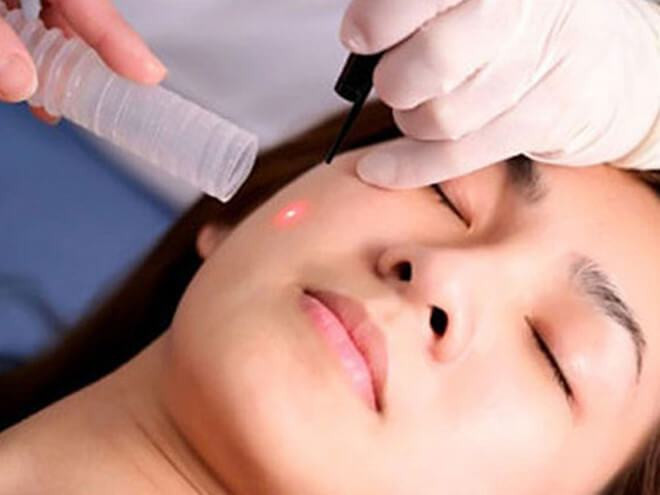 Quy trình tẩy nốt ruồi bằng tia laser